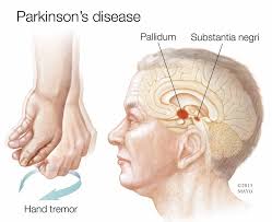 Brain-related symptoms of Parkinson's disease depends on which side of body affected first, study suggests