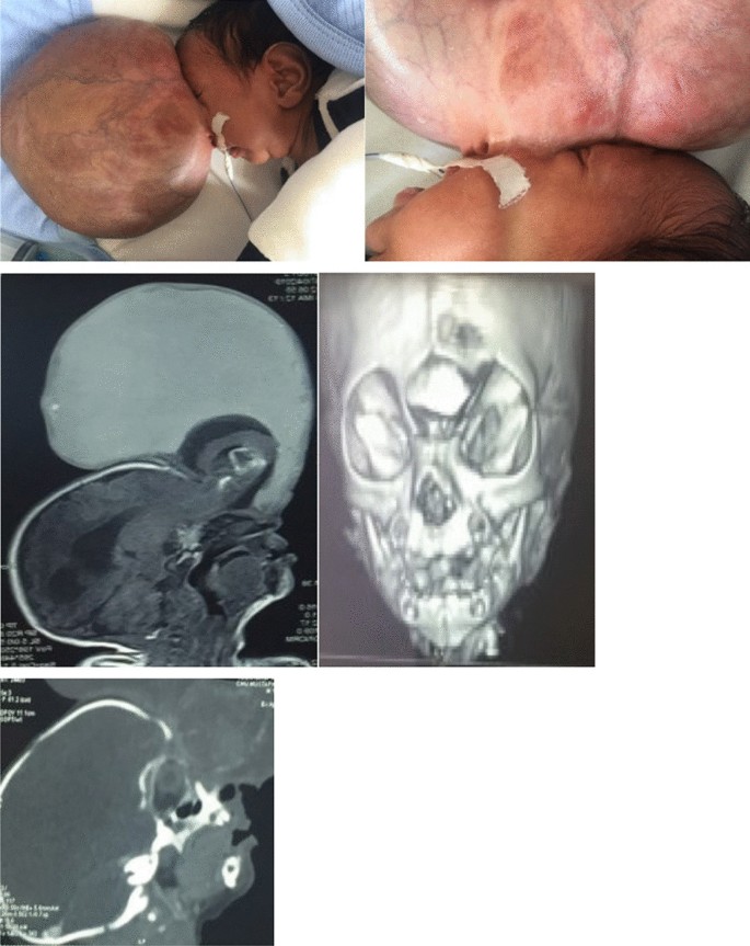 Delhi man makes full recovery in over 2 years; survives six surgeries, rare skull bone TB